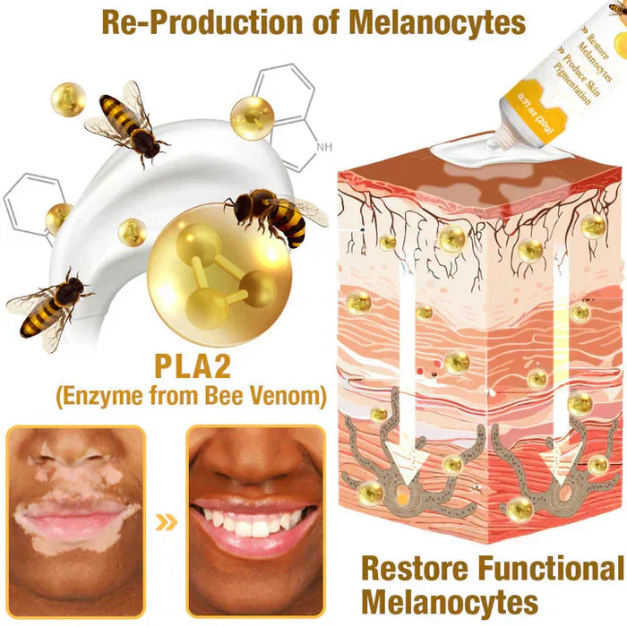 Bee Venom VitiGO Correcting Cream (Pack Of 2)