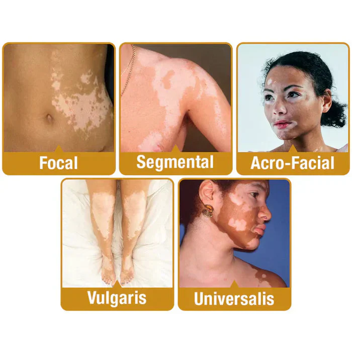 Bee Venom VitiGO Correcting Cream (Pack Of 2)